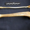Tibia and fibula