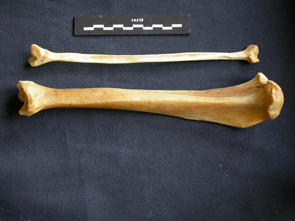 Tibia y fíbula 