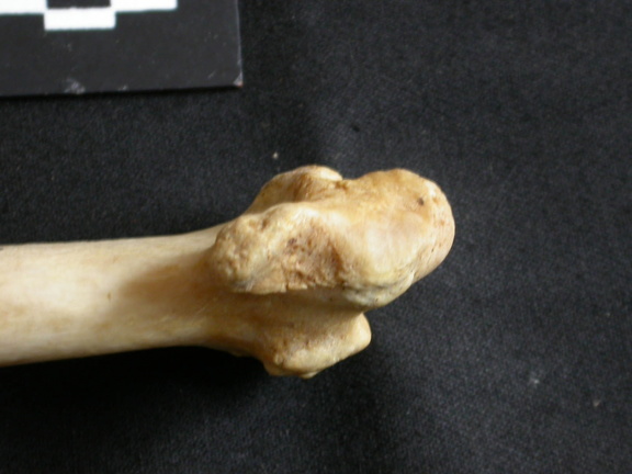 Radius : partie distale