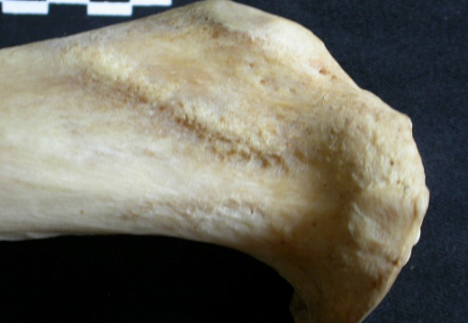  Tibia: proximale part