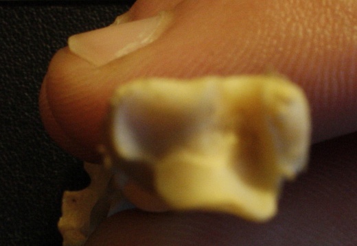 Tibia and fibula: distal end