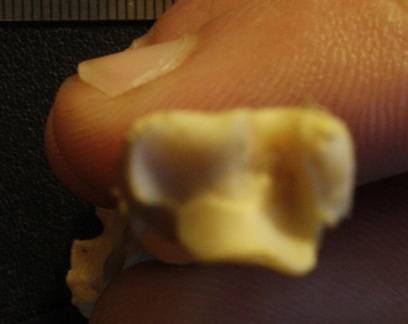 Tibia et fibula : extrémité distale