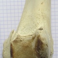 Fémur D dist cran