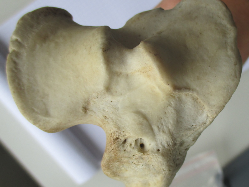 Tibia D prox (15526 visites) Tibia D prox