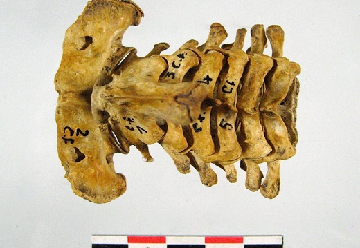 Vertebres cervicales superieur (15995 visites) Vertebres cervicales superieur