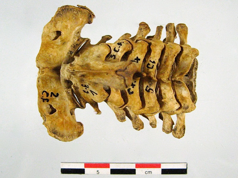 Vertebres cervicales superieur (15996 visites) Vertebres cervicales superieur