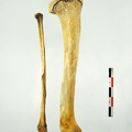 Tibia Fibula posterieur