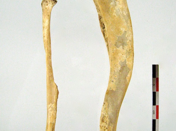 Tibia Fibula lateral 02