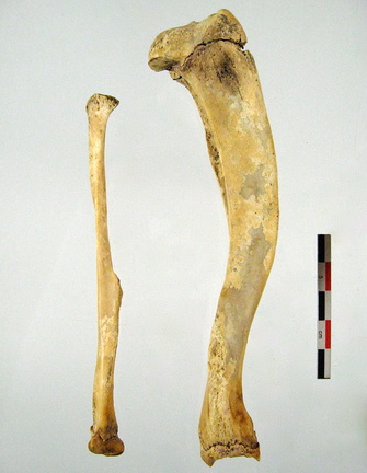 Tibia Fibula lateral 02