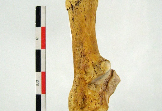 Tarse Calcaneum